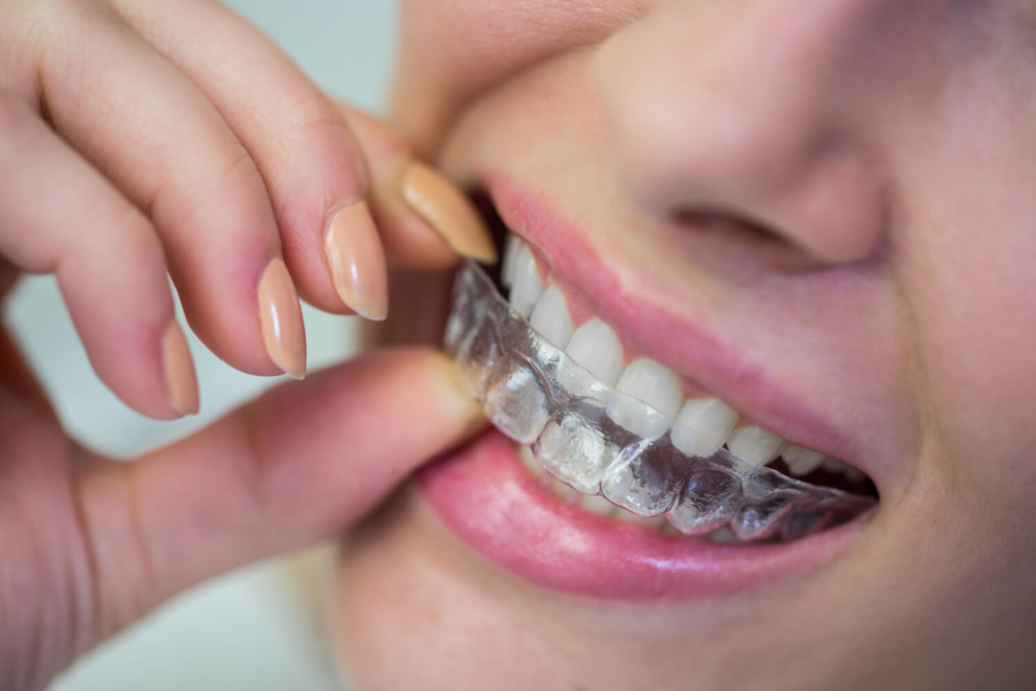 Close de paciente da Clínica Só Riso encaixando alinhador invisível transparente nos dentes para mostrar como evitar que o aparelho fique amarelado.