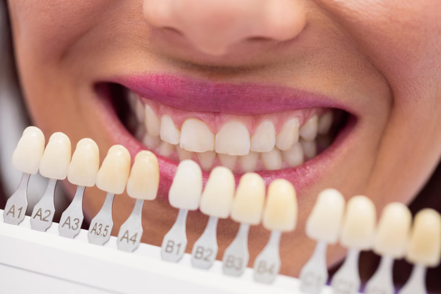 Guia de cores comparando dentes para lentes de contato dental contra manchas de antibiótico na Clínica Só Riso em Patos de Minas.