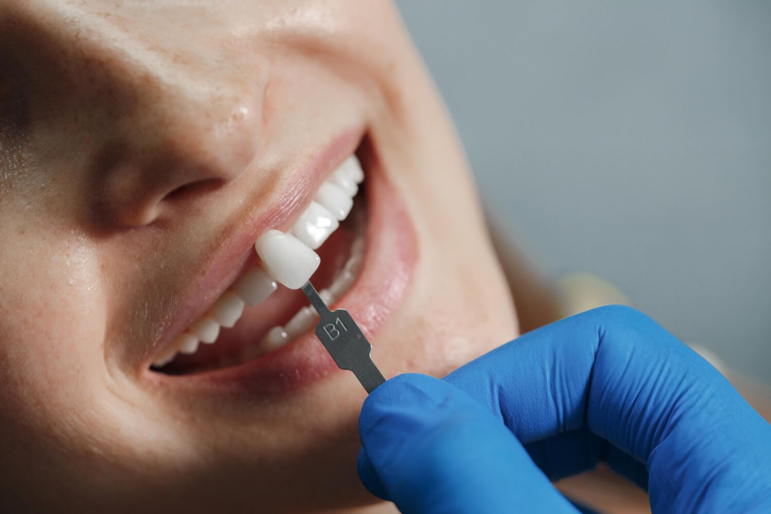 Dentista compara escala de cor com dentes de paciente para planejar lentes de contato dental slim na So Riso em Patos de Minas.