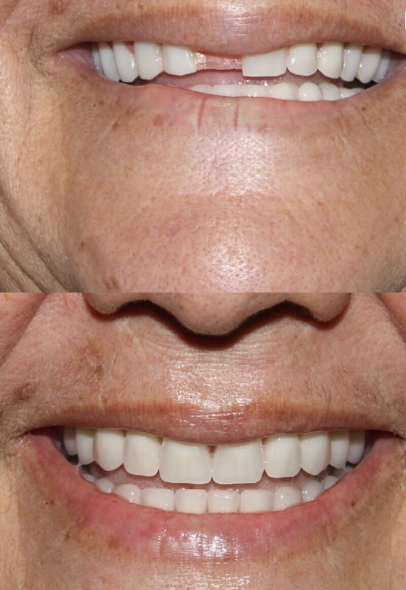 Perdi Um Dente Há Anos, Ainda Posso Colocar Um Implante Dentário