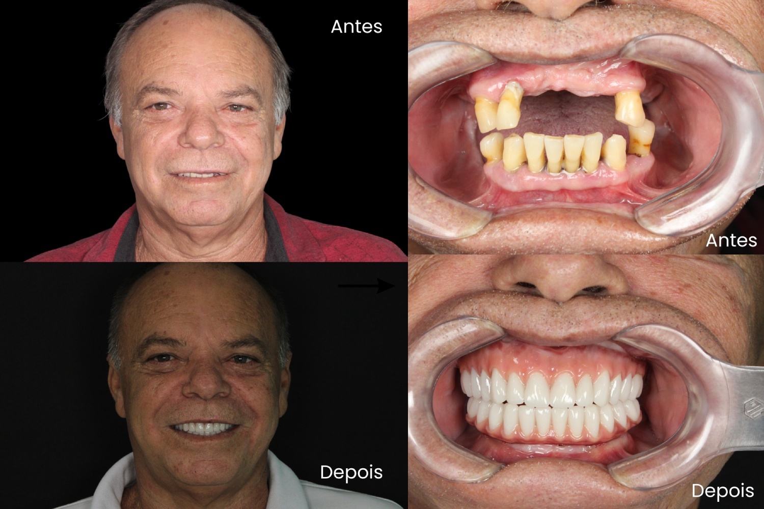 antes e depois prótese protocolo
