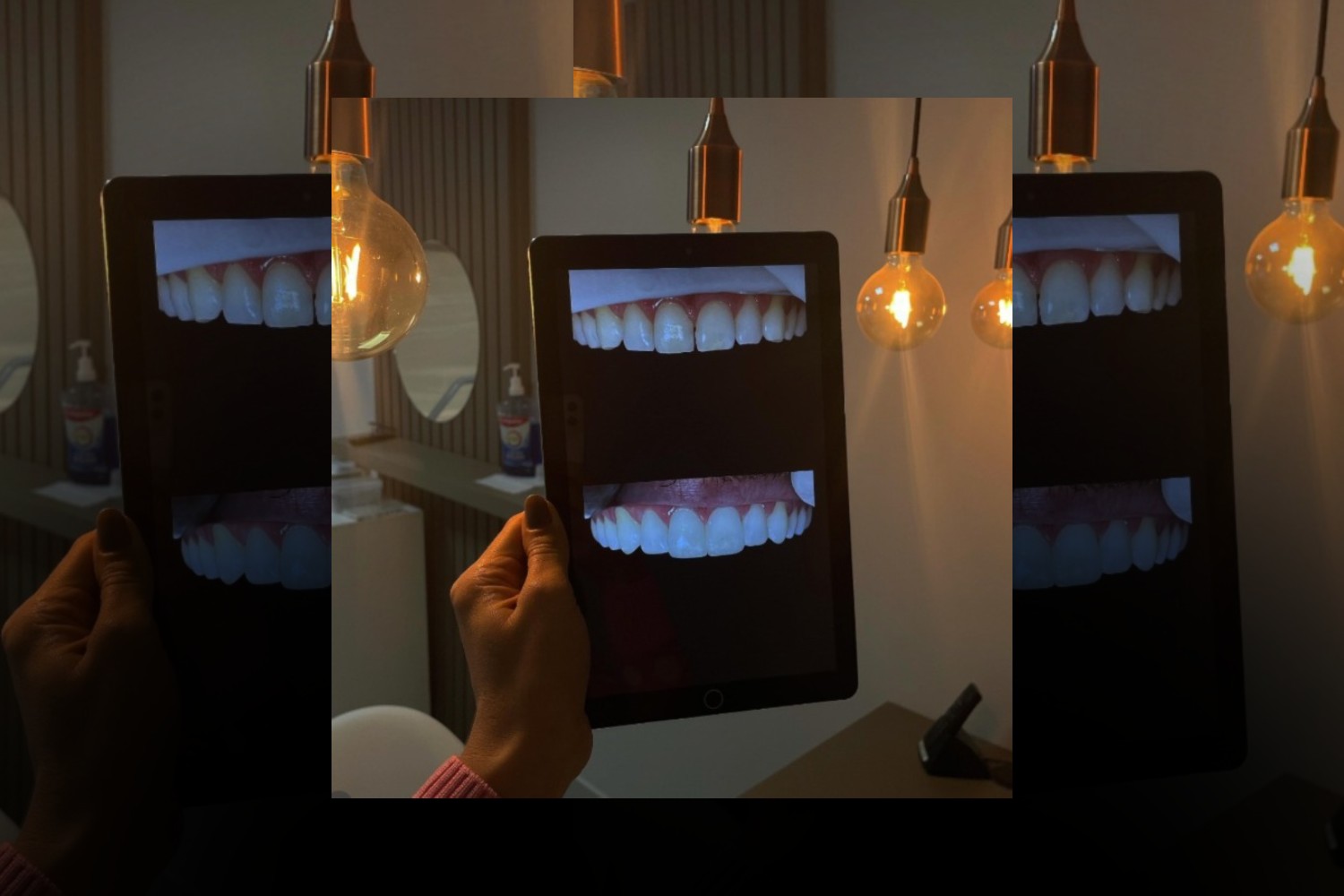 Lentes de Contato Dental Corrigem Dentes Tortos